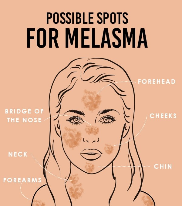 The Difference Between Melasma and Other Skin Spots