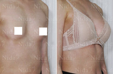 How to fix sagging loose breasts  Nida Esthetic Cosmetic Surgery Bangkok