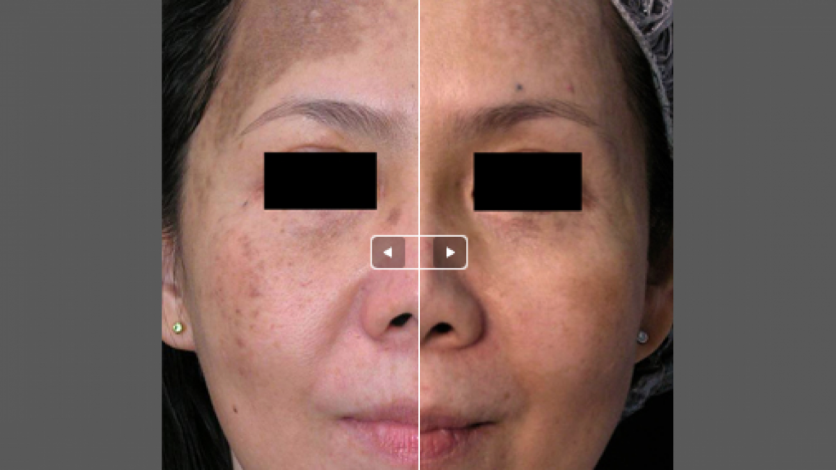 RevLite Laser Full Face Treatments, 57% OFF