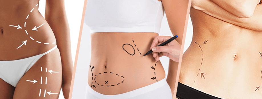 Laser Lipolysis - Midriff Shaper (Ladies) – The Laser Beautique