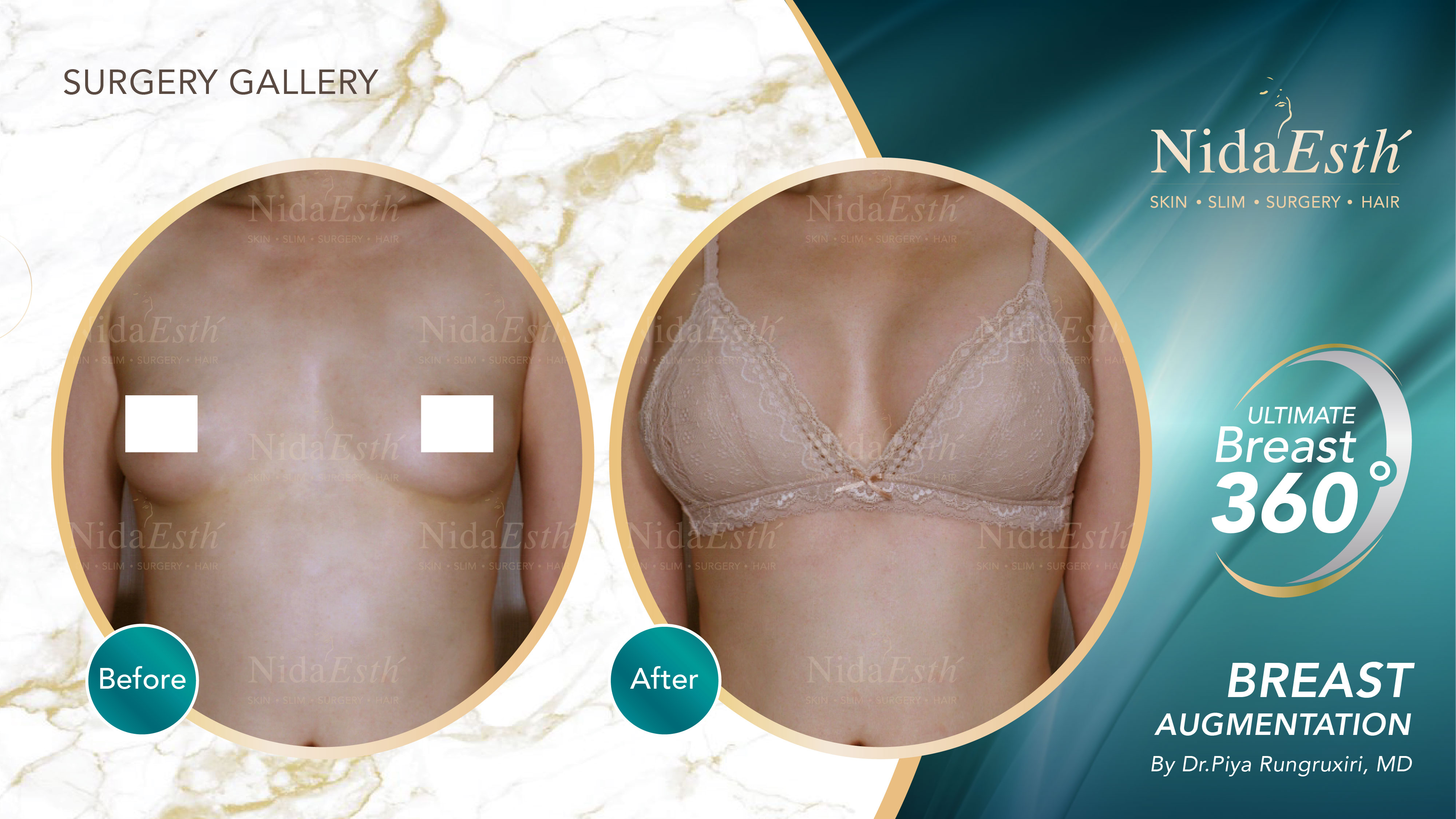 Ultimate Breast 360 °  Nida Esthetic Cosmetic Surgery Bangkok
