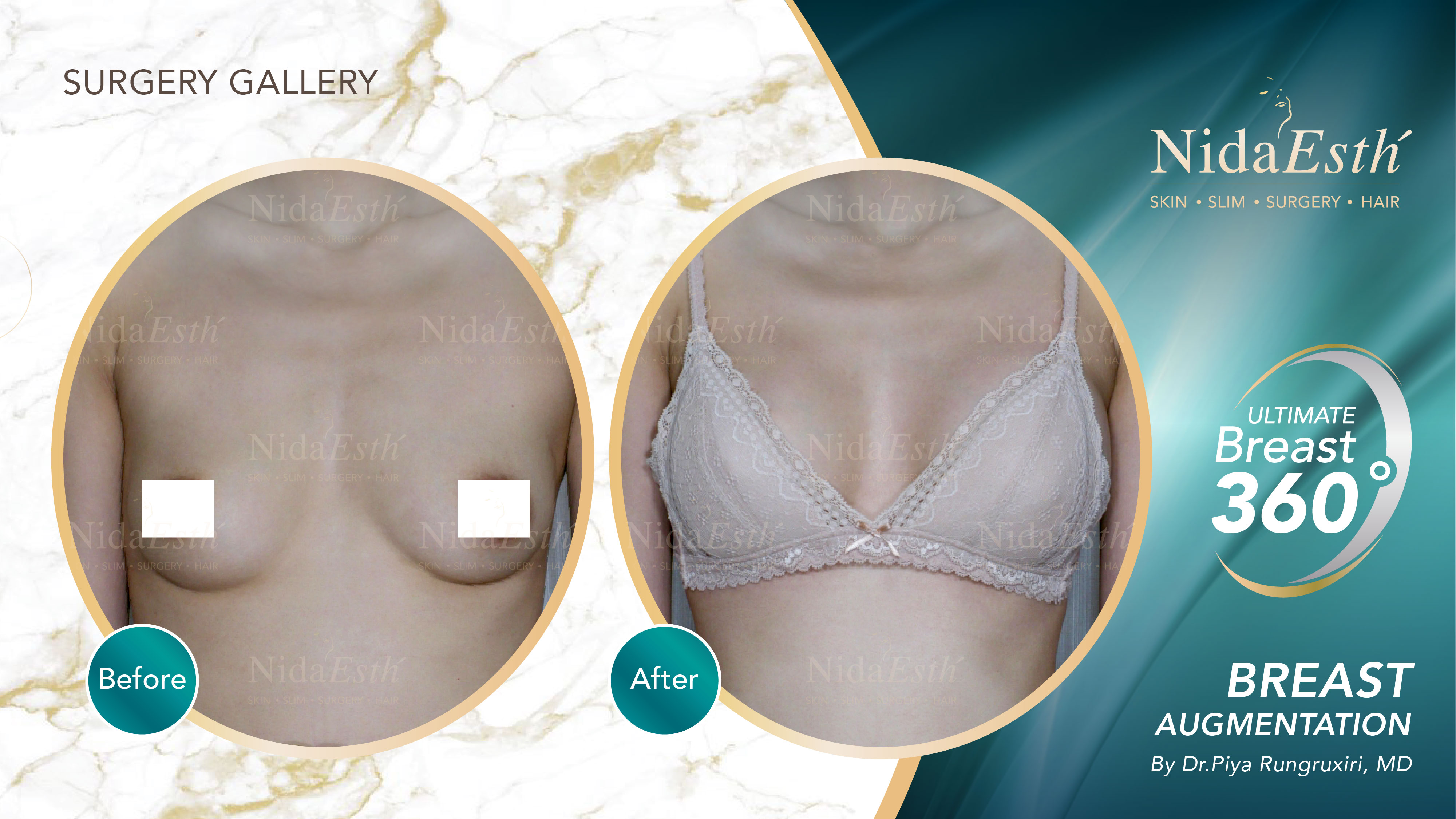 Ultimate Breast 360 °  Nida Esthetic Cosmetic Surgery Bangkok