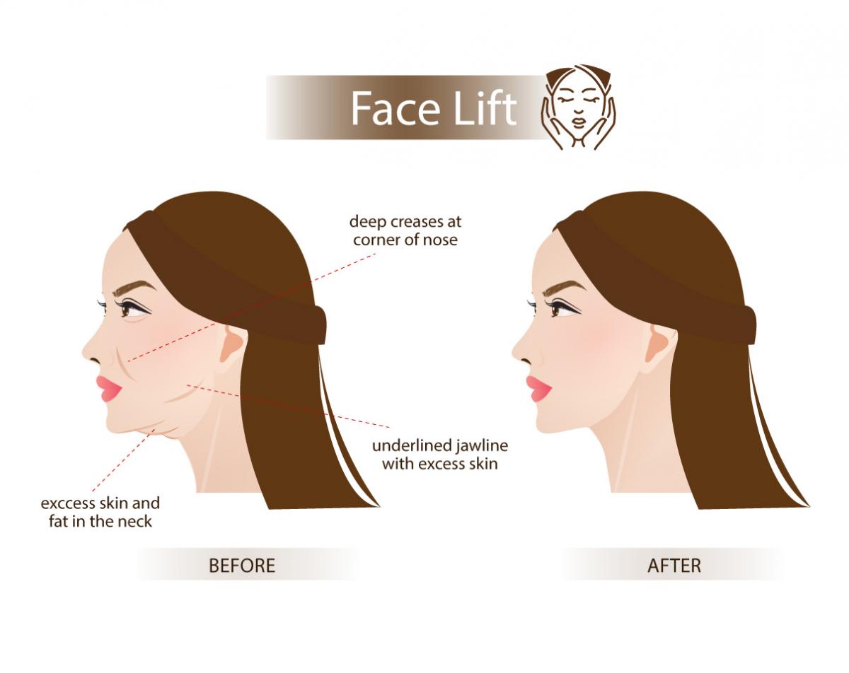 Full Face Lift  Nida Esthetic Cosmetic Surgery Bangkok