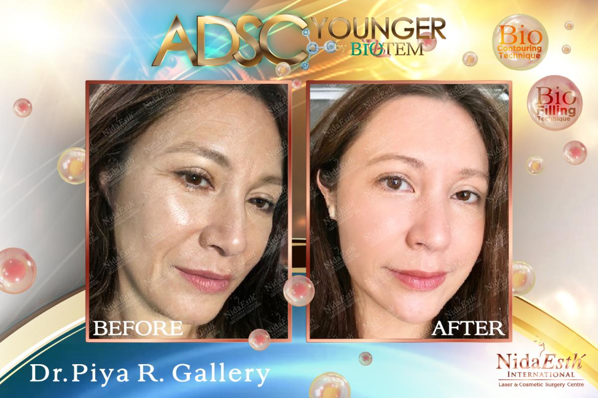 ADSC Younger Before After