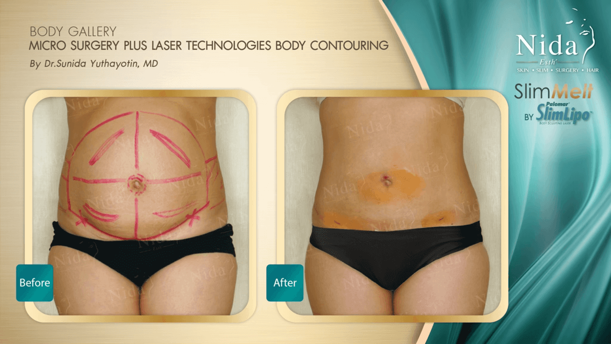 Seattle Liposuction Surgery - Smart Lipo Body Contouring - Belred