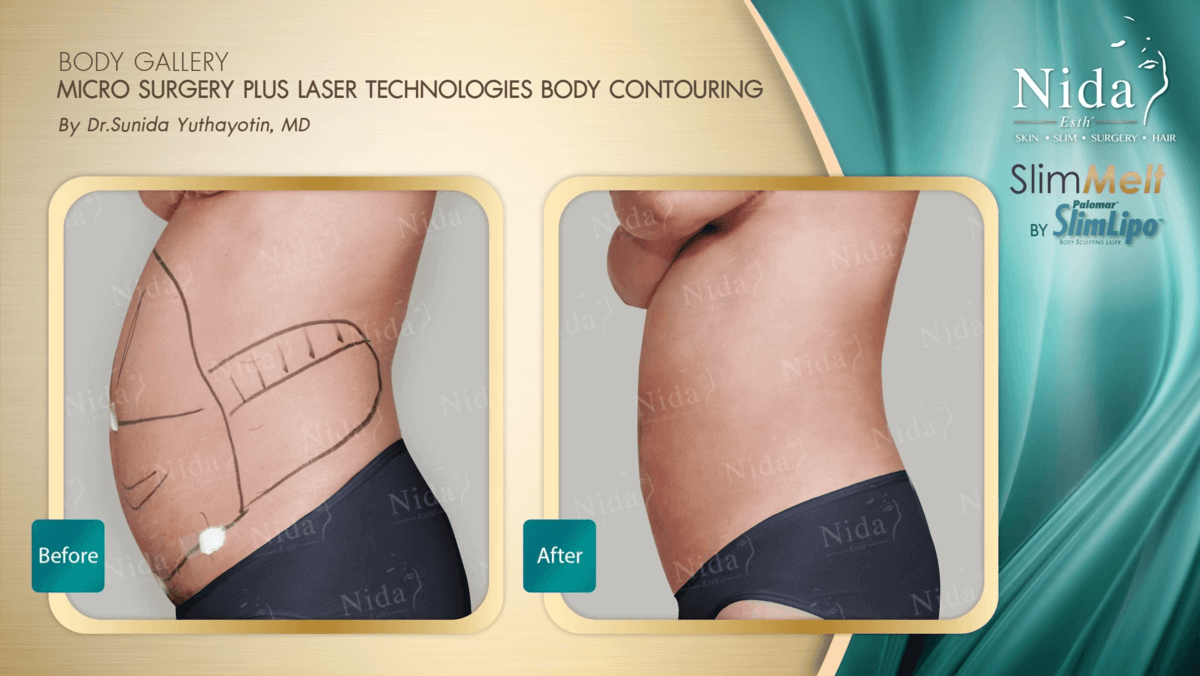 Smart Liposuction Photo Gallery - Belred Cosmetic Surgery