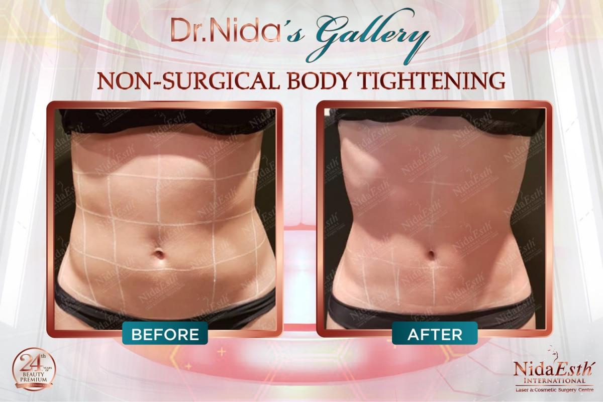 tightsculpting Before after
