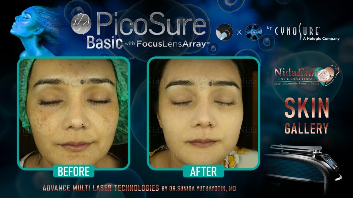 PicoSure before after