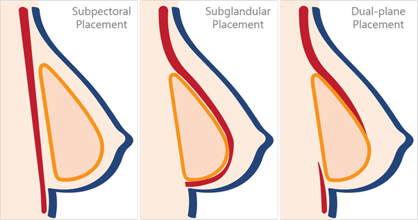 Why Are My Breasts Deformed When I Flex? - Esteem Cosmetic Studio