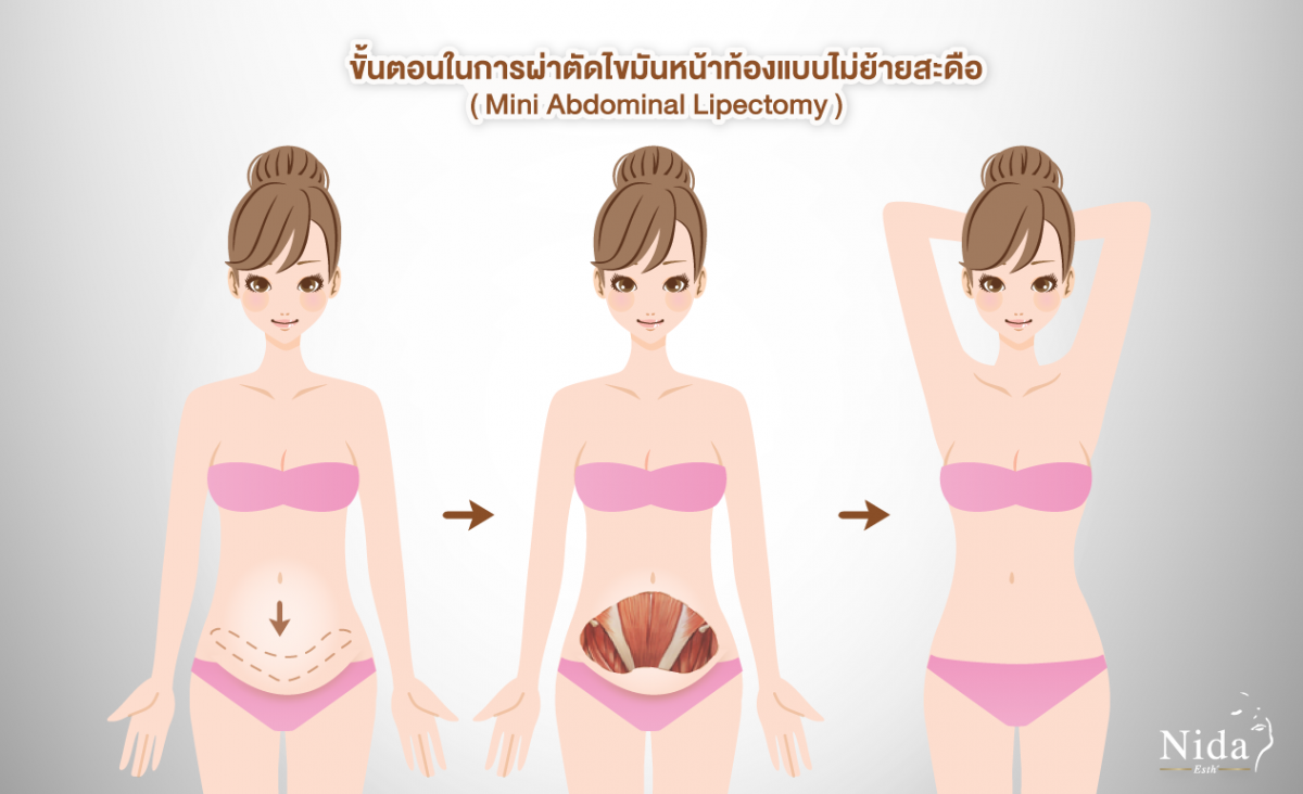 Tummy Tuck Operation  Nida Esthetic Cosmetic Surgery Bangkok